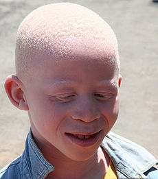 Universal Vitiligo