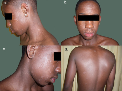 Pityriasis