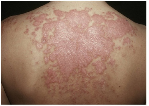 Vitiligo Symptoms Causes And Treatment Skinpractice