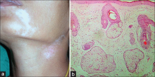 Focal Vitiligo