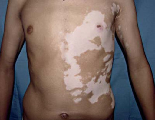 Segment Vitiligo