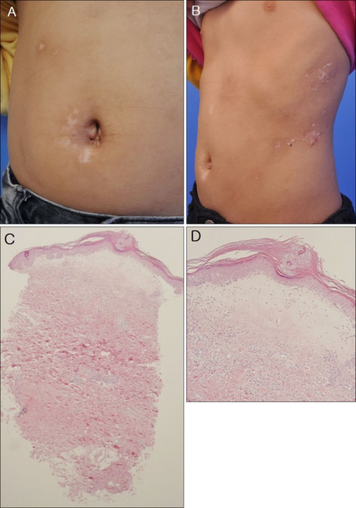 Lichen sclerosis et atrophic