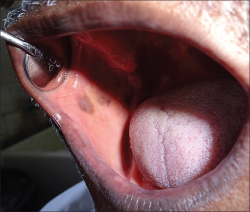 Mucosal Vitiligo
