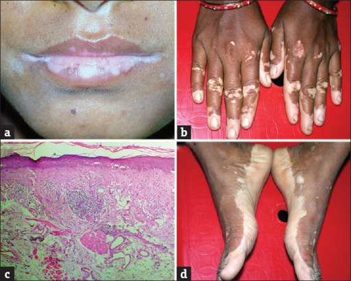 Acrofacial Vitiligo