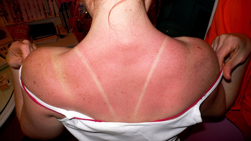 Severe Sunburn