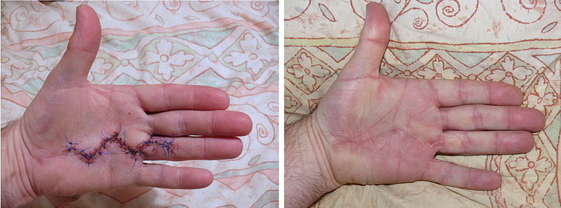 Scar Healing