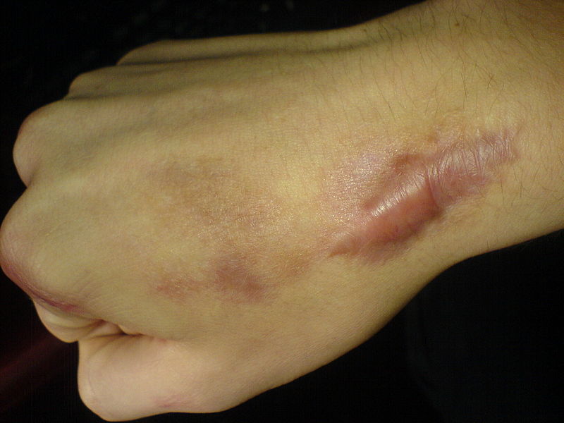 Keloid Scar