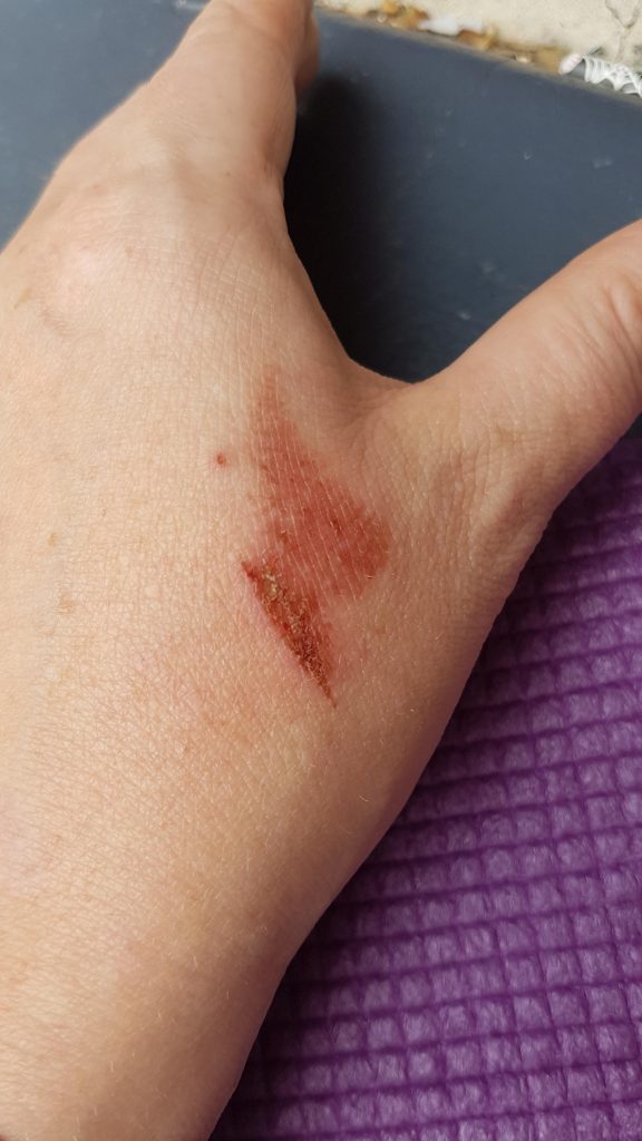 Burn scar image