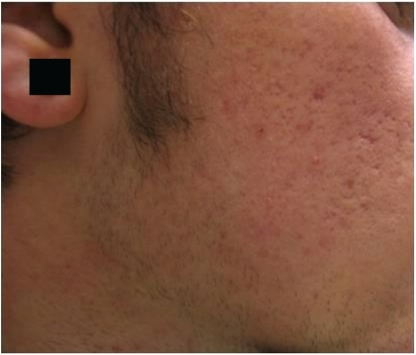 Acne Scars