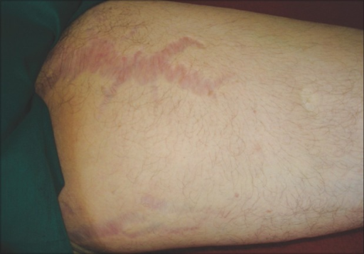 Stretch Marks