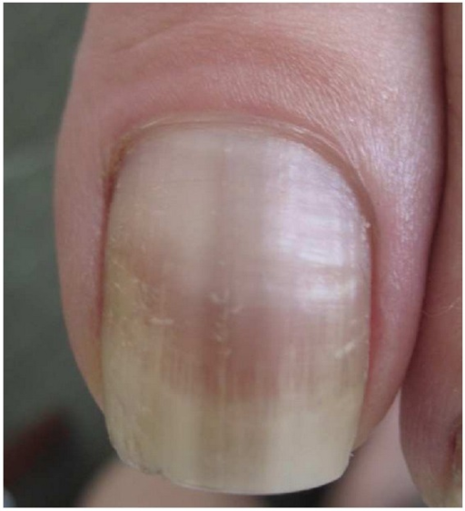Traumatic melanonychia