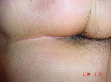 Inverse Psoriasis