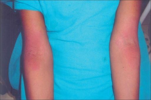 treatment white skin egg (Chronic Hives) Diagnosis Causes, Types, Urticaria