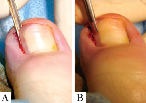 Ingrown nail Treatment