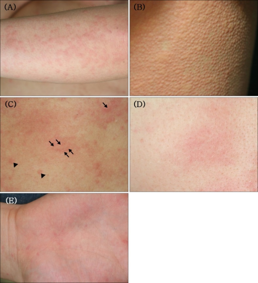 Urticaria Chronic Hives Causes Types Diagnosis And Treatment Skinpractice