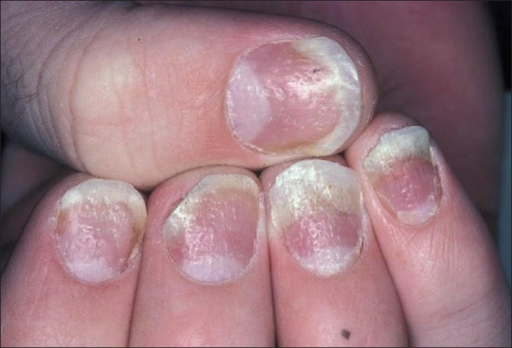 Nail Psoriasis