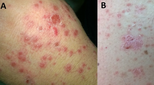 Guttate Psoriasis
