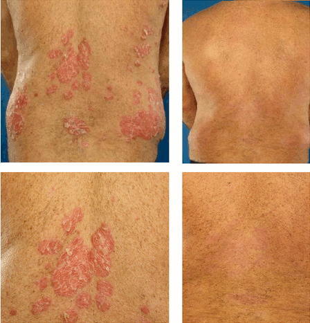 Psoriatic Arthritis