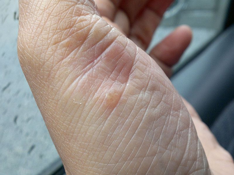 can methotrexate treat psoriasis