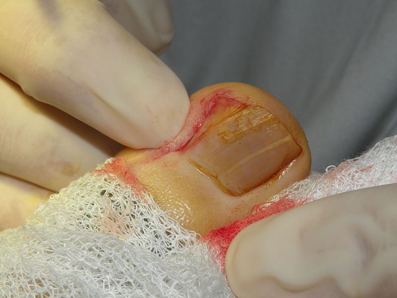 Ingrown Toenail