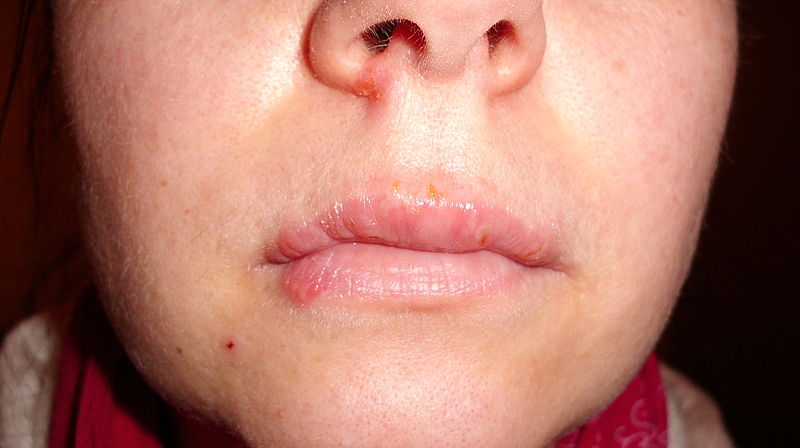 Herpes Simplex Type I