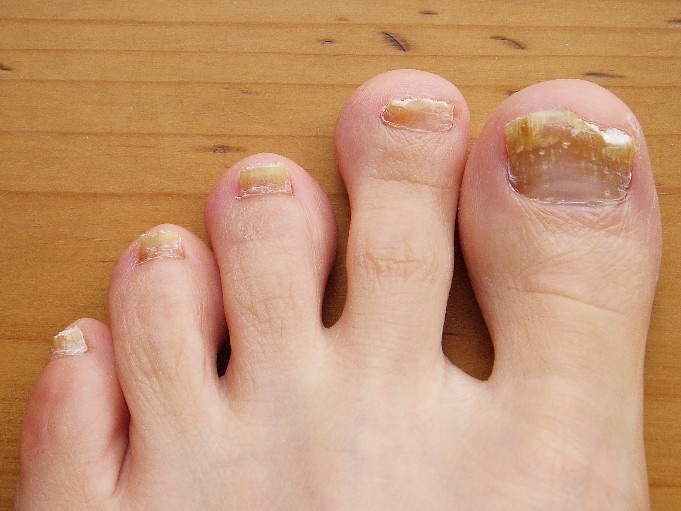 How to choose an effective nail fungus beauty?