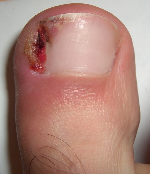 Which is the best way to remove ingrown nails