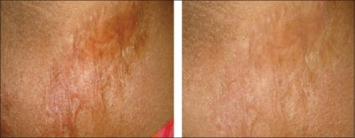 silicone gel for scar removal