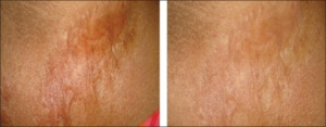 Before after burn scar cream