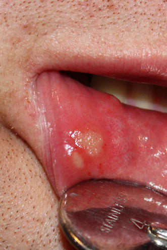 Canker Sore fix