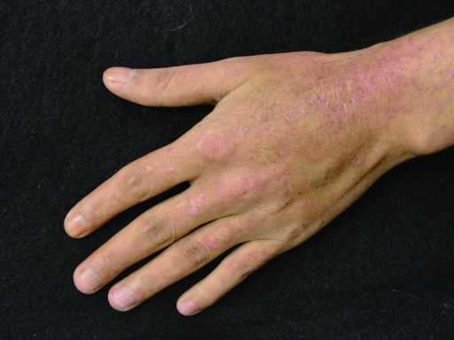 Flat papules on the dorsum of the left hand corresponding to flat warts