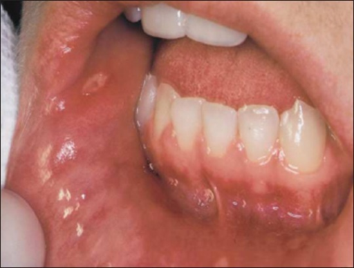 Best beauty for Canker sores