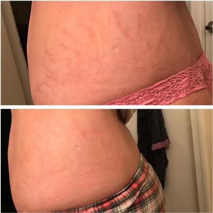 Management of new stretch marks