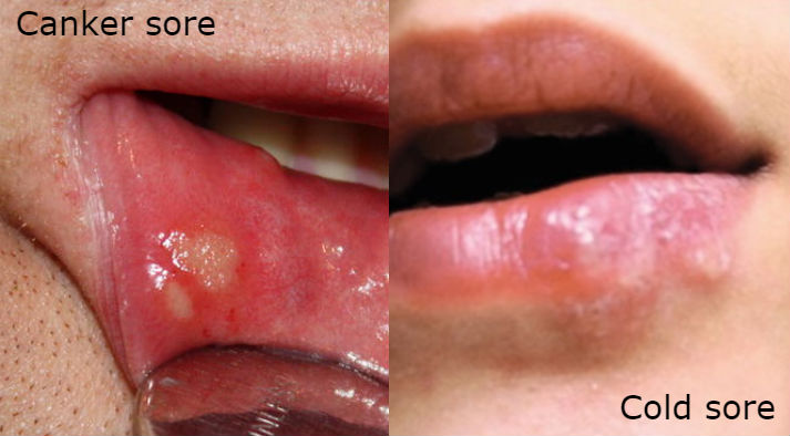 difference between cold and canker sores