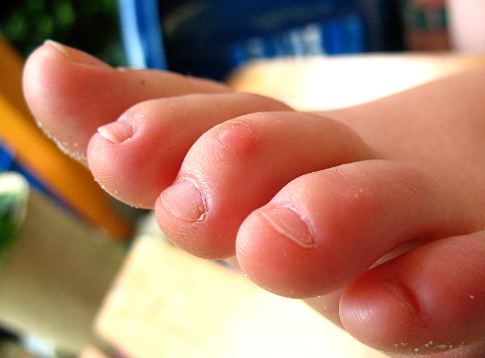 best treatment for corns between toes