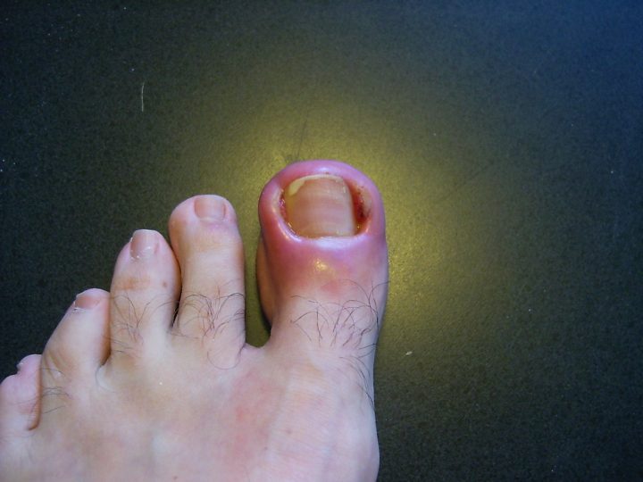 Ingrown Nail