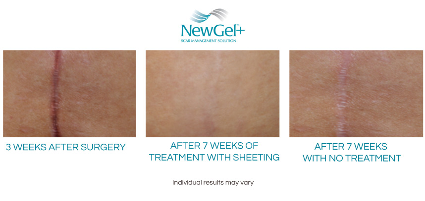 NewGel+ Silicone Gel Strips