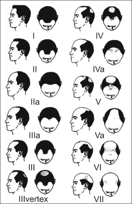 Men Baldness