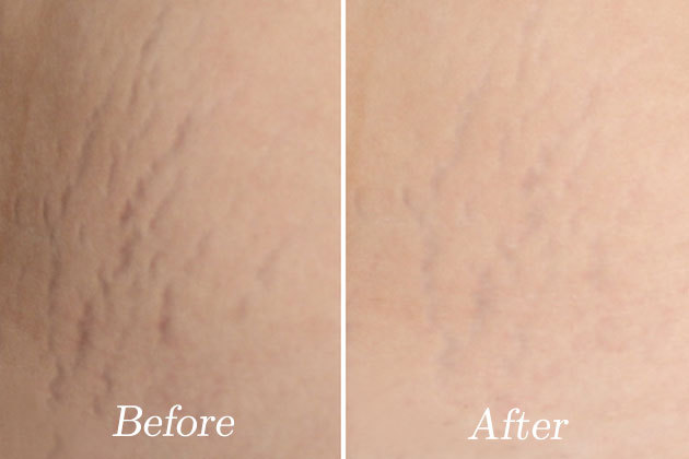 Strivectin stretch marks before and after