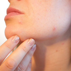 Best acne spot fix