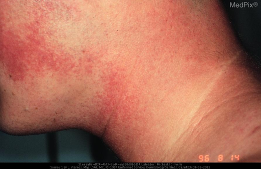 Diabetic Skin Rash Identification