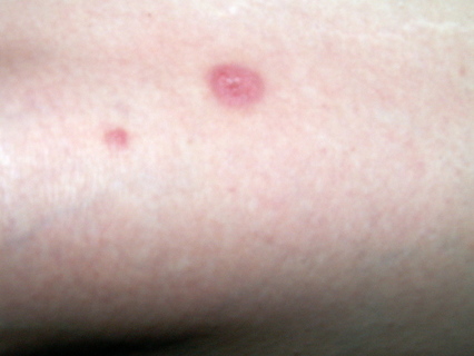 does itching ringworm make it worse