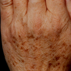 Microdermabrasion for age spots