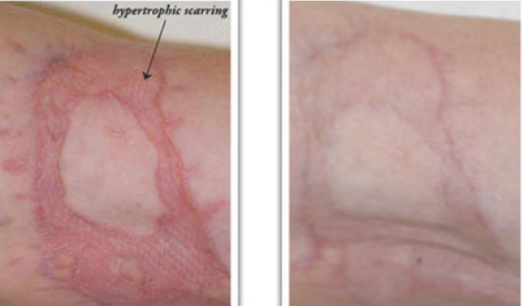 NewGel+ effect on hypertrophic scar