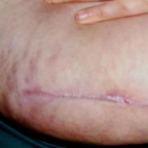 Microdermabrasion for scars