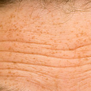 Microdermabrasion for wrinkles