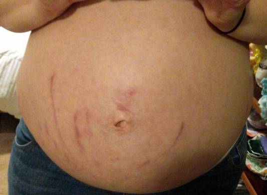 Stretch marks affecting the belly