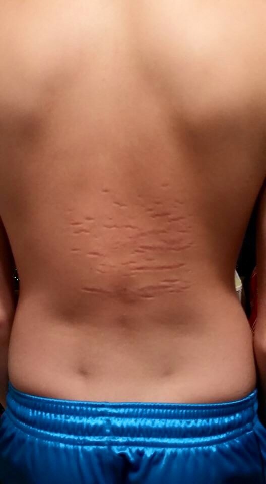 Stretch marks affecting the back