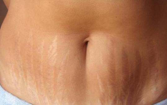 Belly stretch marks