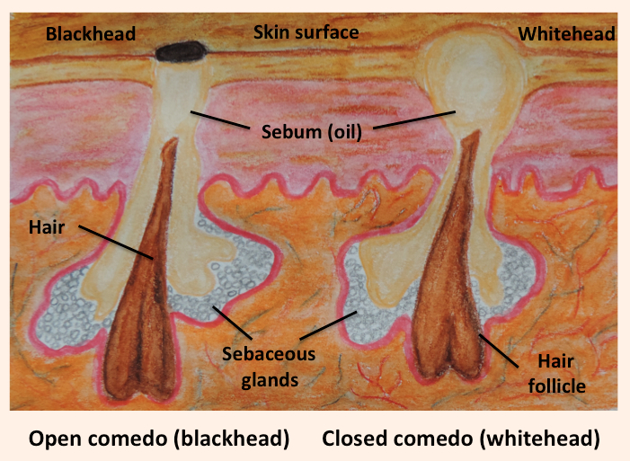 Types comedones